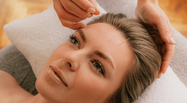 Acupuncture du visage | Treatwell